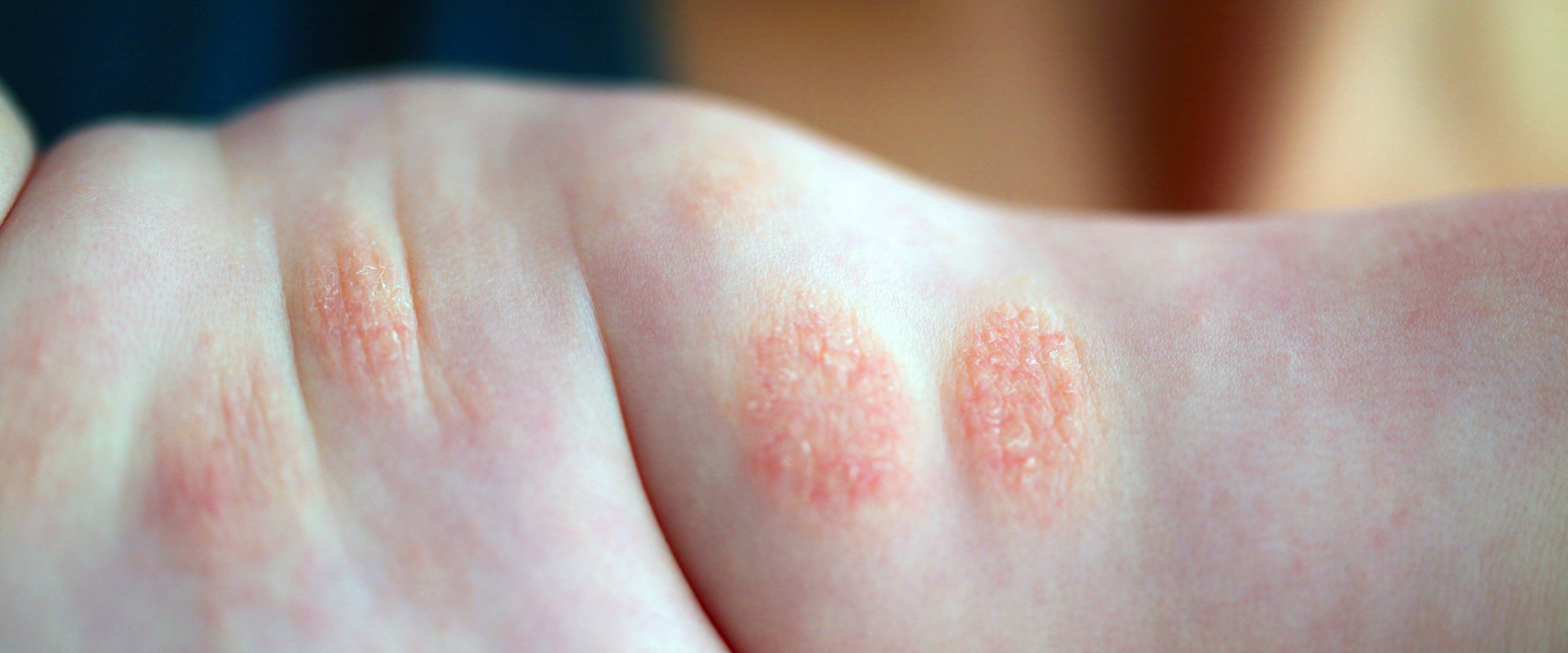 Baby Eczema Care: Bathing, Moisturizing & Safe Skincare Tips for Sensitive Skin