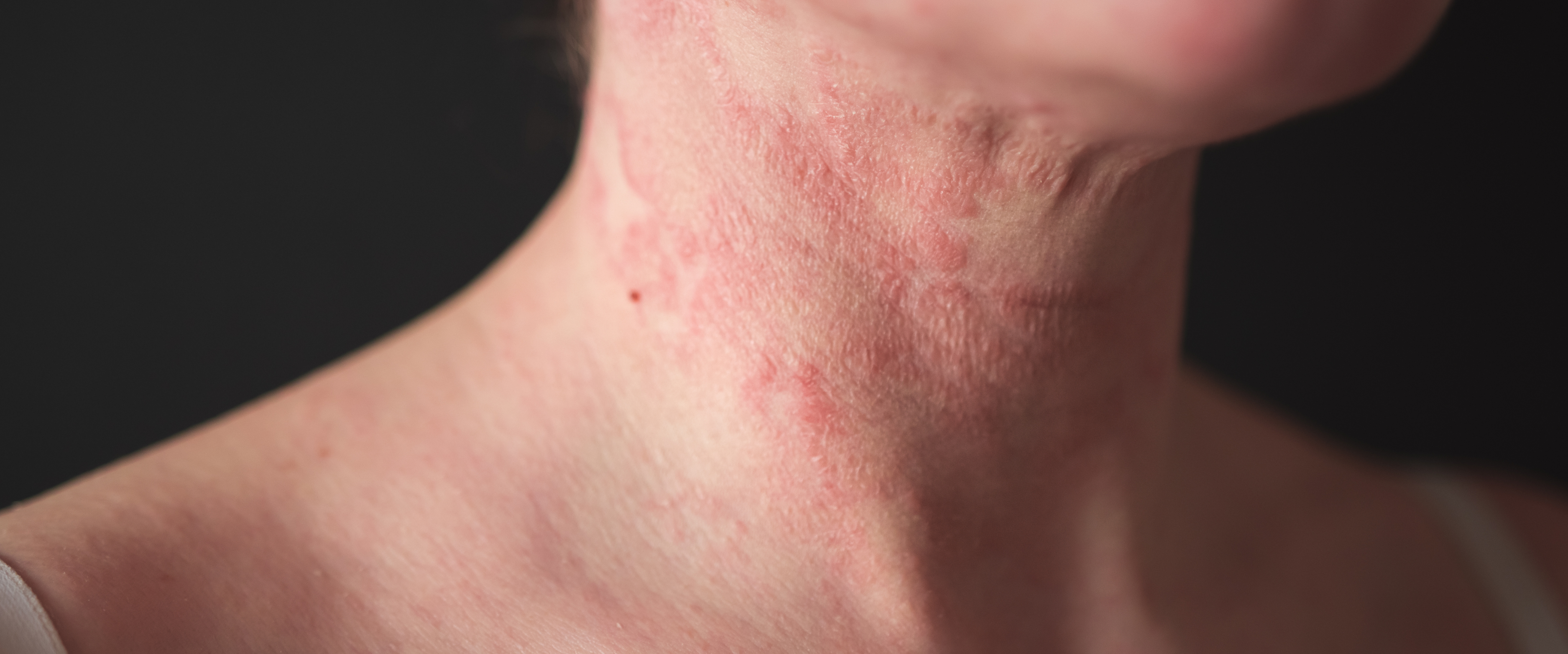 Neurodermitis (Atopic Dermatitis) in Children and Adults: Causes, Symptoms & Treatments