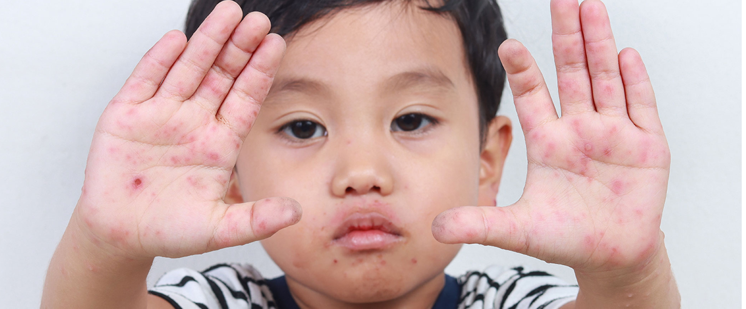 Hand, Foot and Mouth Disease (HFMD) in Children: Symptoms, Causes, Treatment and Prevention